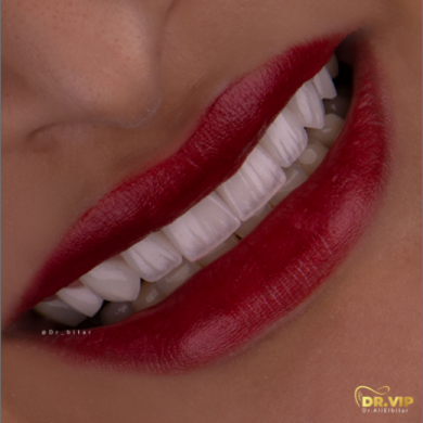 إبتسامة هوليوود