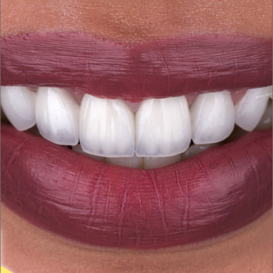 ابتسامة هوليوود