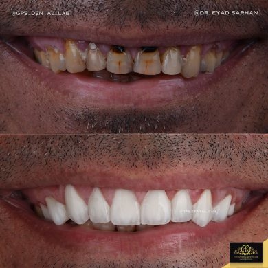 اسنان قبل وبعد
