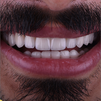 تجارب ابتسامة هوليود