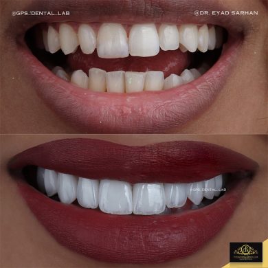 تجميل اسنان