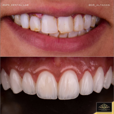 تجميل الاسنان